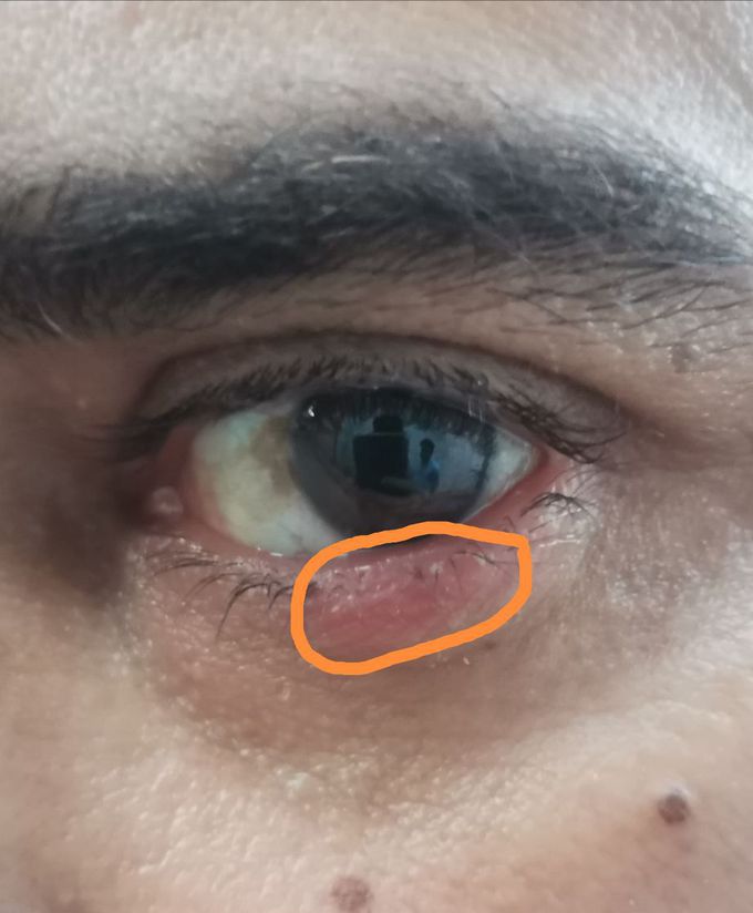 Eye disease