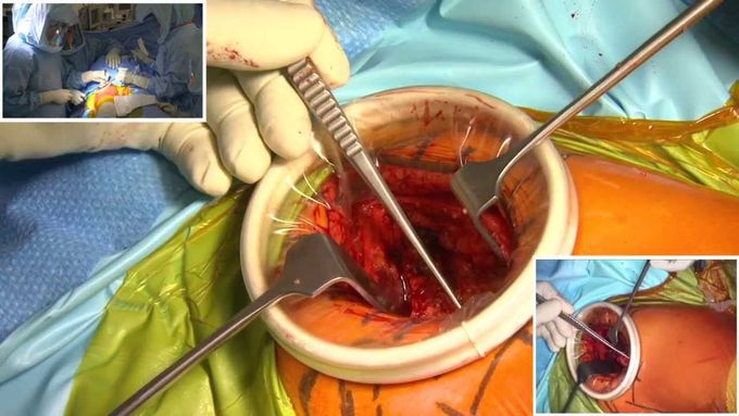 Total Hip Replacement (Anterior Approach, Minimally Invasive)