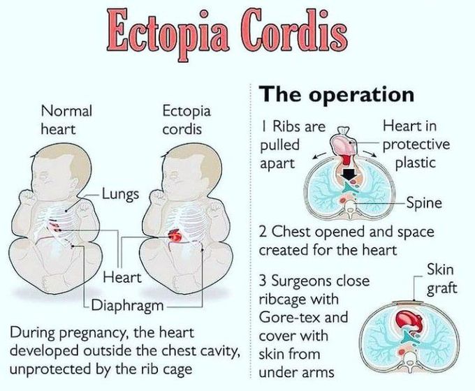 Ectopia cordis