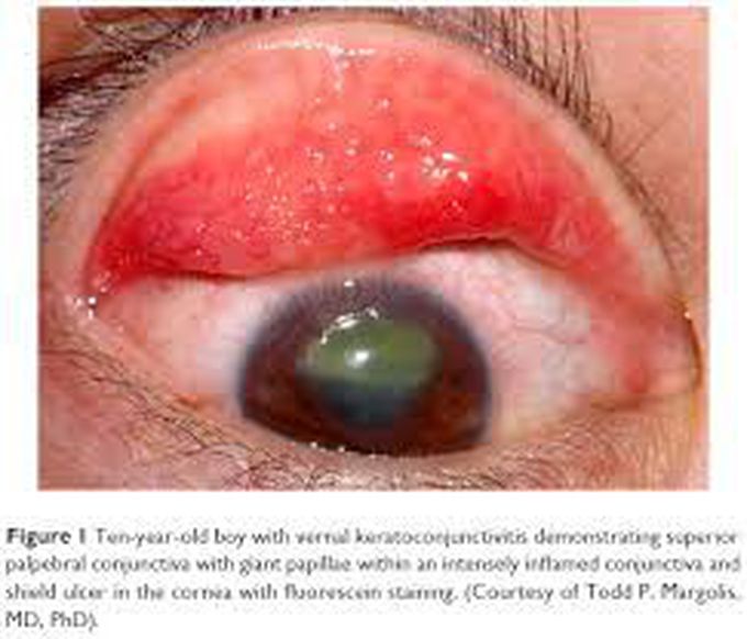 Keratoconjunctivitis Symptoms