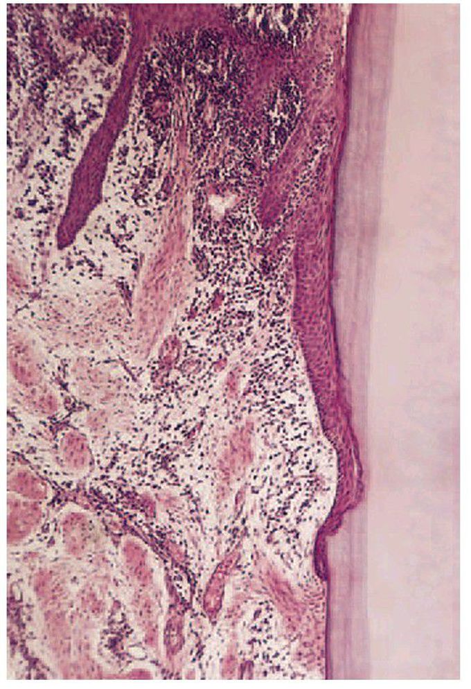 Chronic periodontitis