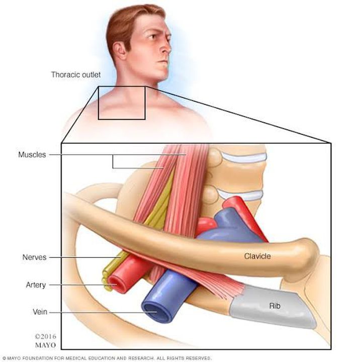 Thoracic Outlet Syndrome