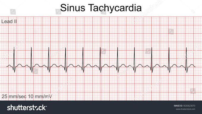 Sinus Tachycardia