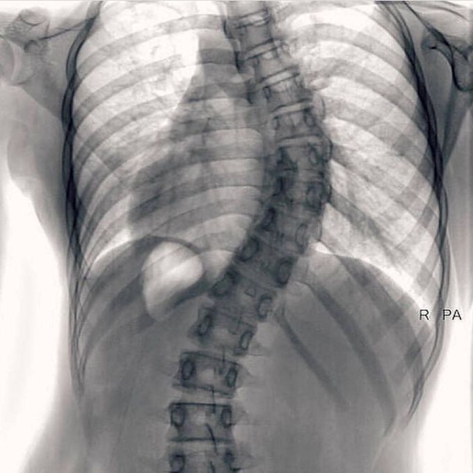 Scoliosis