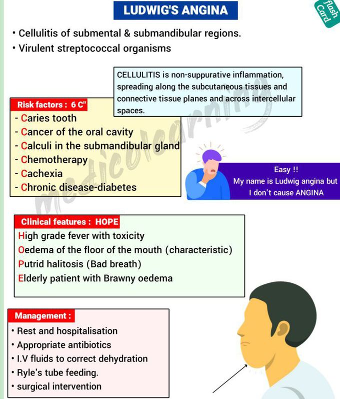Symptoms of Ludwig Angina