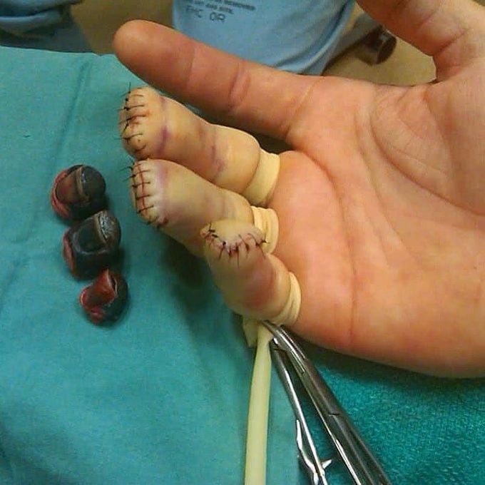 Fingertip amputation