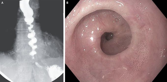 Corkscrew Esophagus in Achalasia