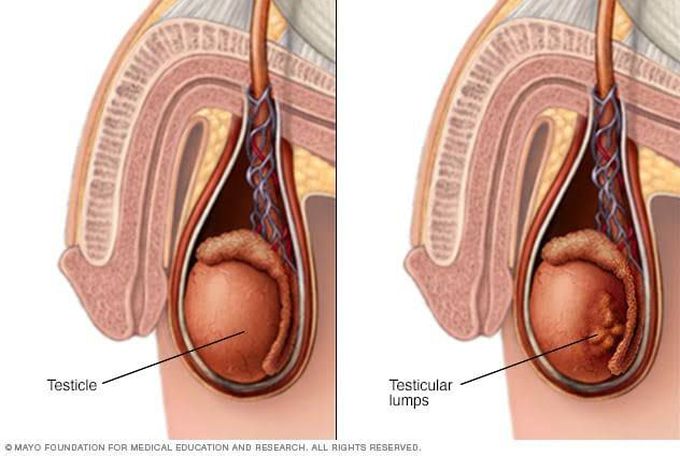 Causes of testicular cancer