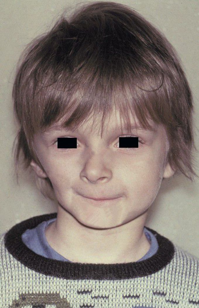 Progressive hemifacial atrophy