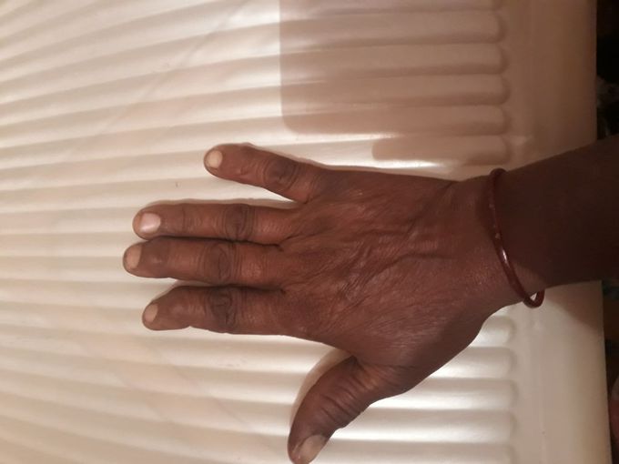 A 52 year old female patient presented with twisted distal interphalangeal joints, prominent in index finger.diagnosis and treatment please