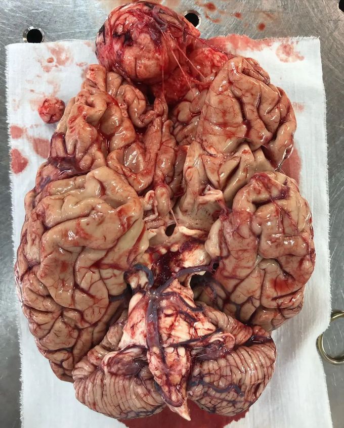 Meningioma