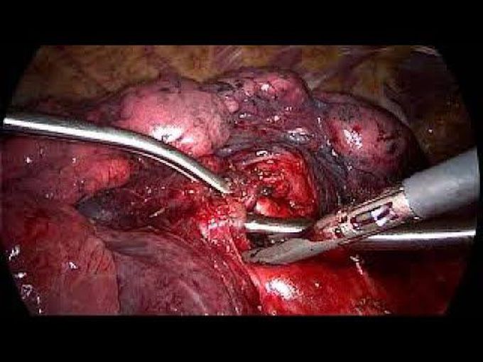 UK Use of Enseal Tissue Sealer for Pulmonary Right Upper Lobectomy