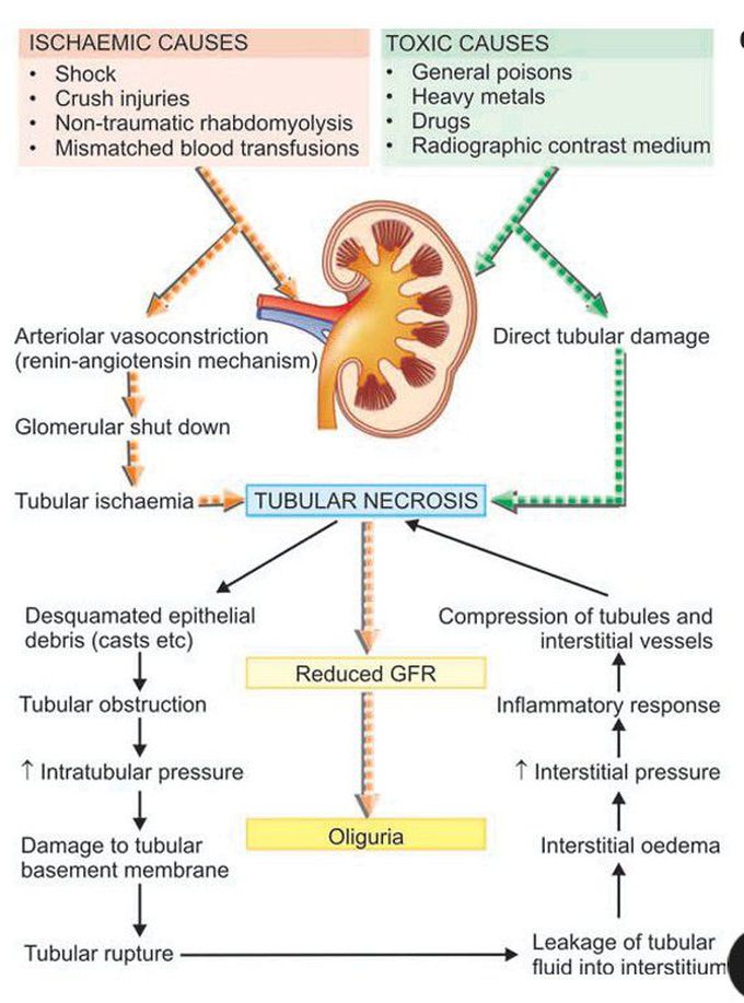 Acute tubular necrosis