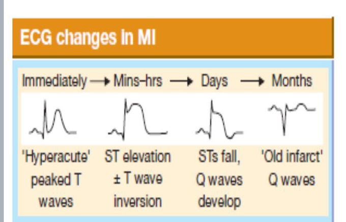 ECG MI