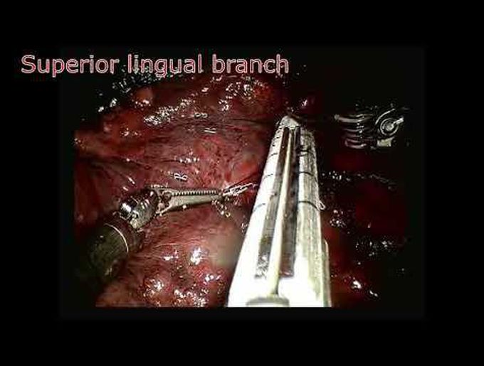 Management of Anterior Pulmonary Artery Branch During Robotic-Assisted Left Upper Lobectomy