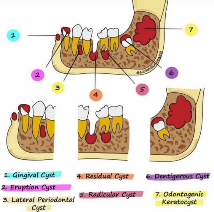 Cyst Oral Pathology Medizzy