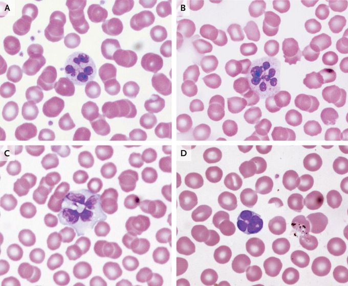 Botryoid White-Cell Nuclei