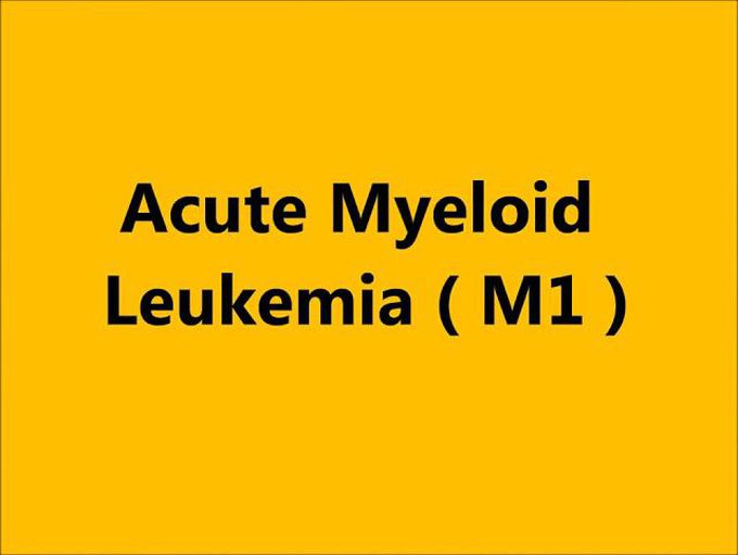 How is a acute myeloid leacumia "acute myeloid leacumia"by vijaysharma"Vijay Sharma