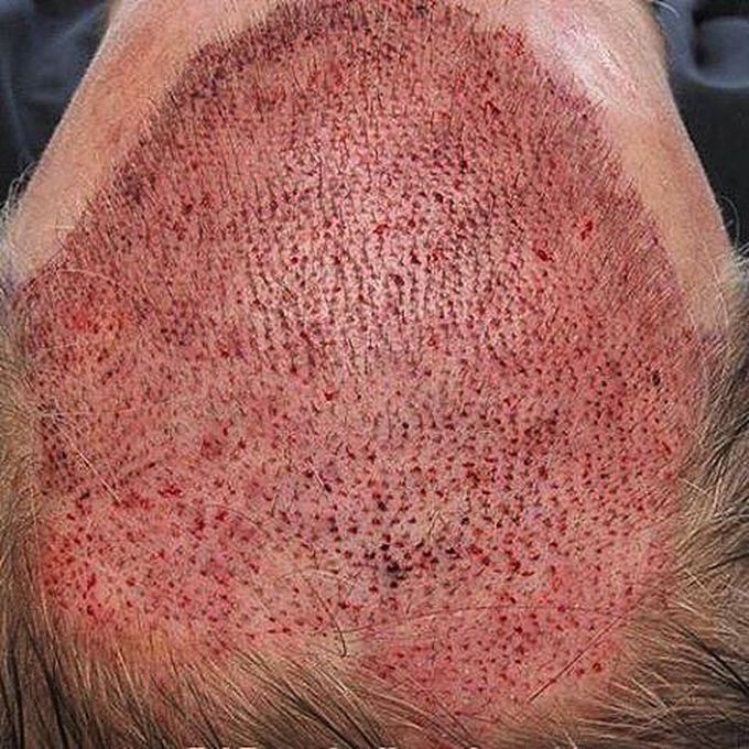 Photo of after About two Weeks of a Hair-Transplant