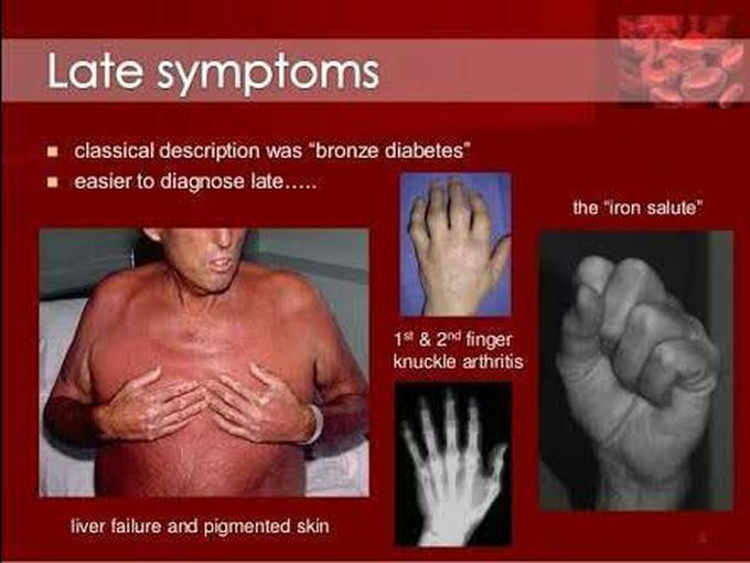 Bronze diabetes symptoms