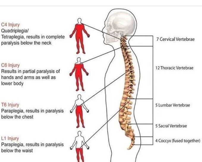 Extent of Paralysis