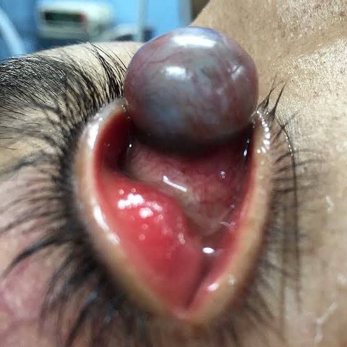 Anterior Staphyloma