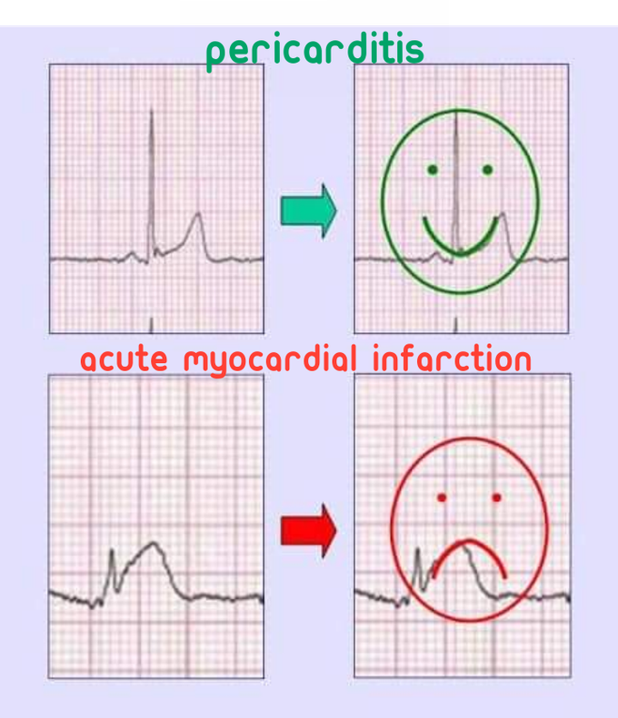 Pericarditis - MEDizzy