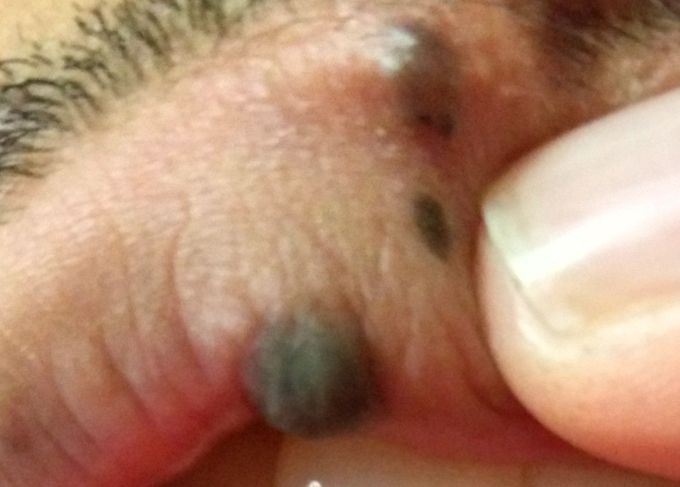 Is it possible to get all 3 freckles removed?