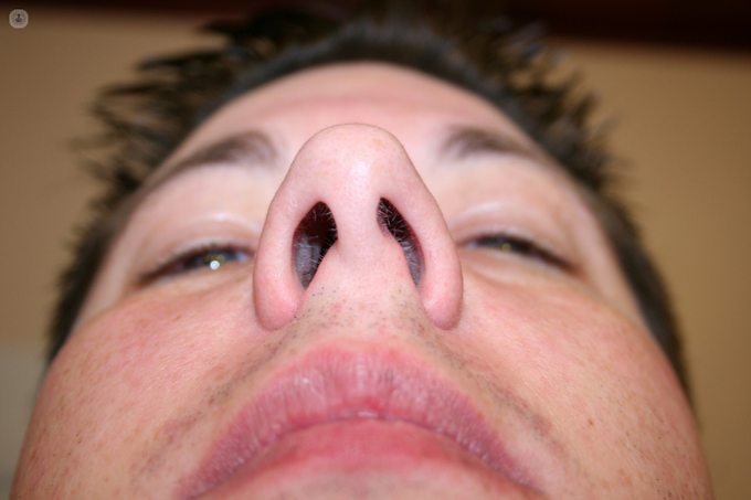 Nasal deformities