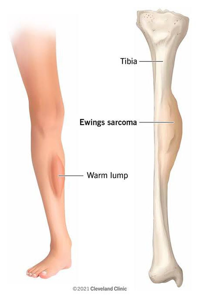 Ewing Sarcoma Symptoms