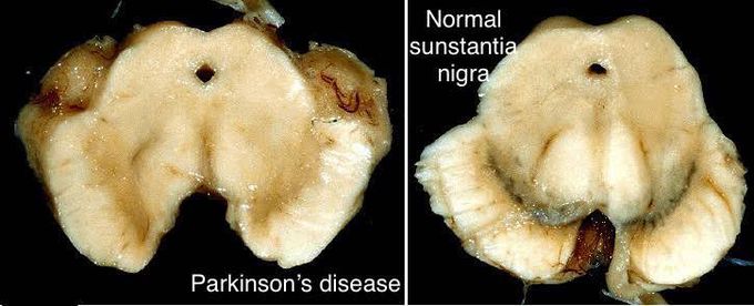 Parkinson’s disease