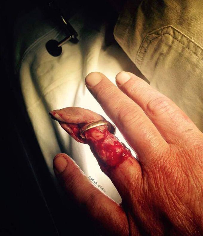 Finger degloving