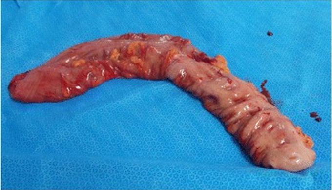 Sigmoid Volvulus In 13-Year-Old
