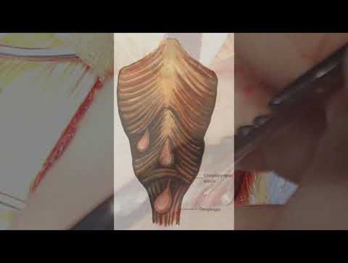 Surgical Treatment of Zenker's Diverticulum