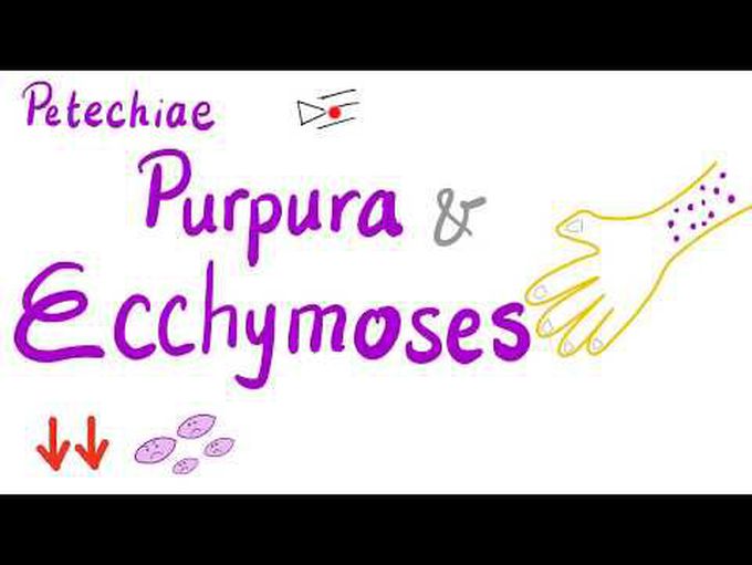 Petechiae, Purpura and Ecchymoses