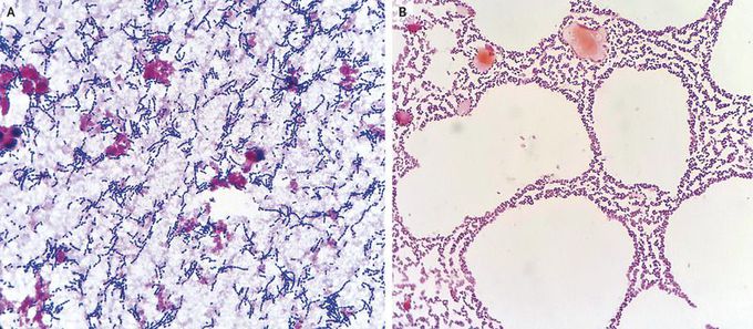 Pneumococcal Bacteremia and Meningitis