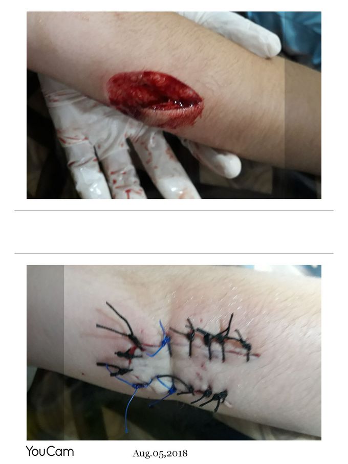 Injury  by trauma