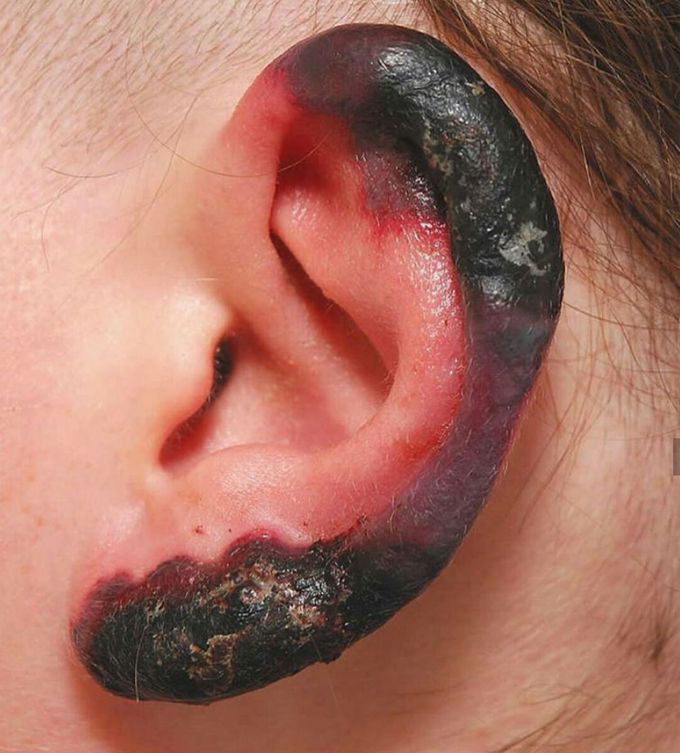 Necrotic skin lesions