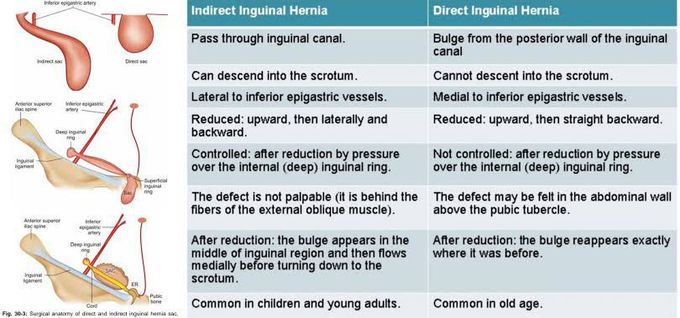 Indirect vs Direct Inguinal hernia