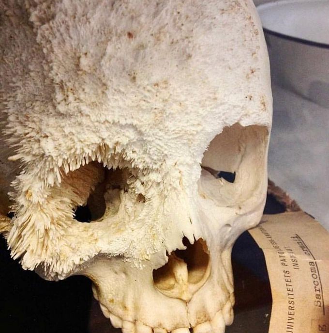 A rare and fascinating case of cranial osteosarcoma!  