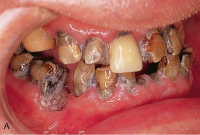 Radiation cervical caries