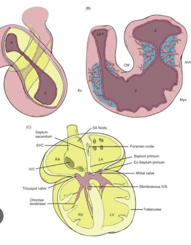 Cause of Endocardial cushion MEDizzy