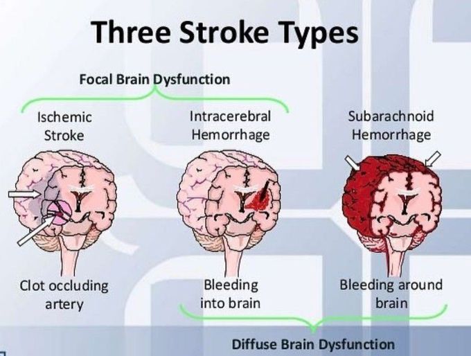 Three Stroke Types