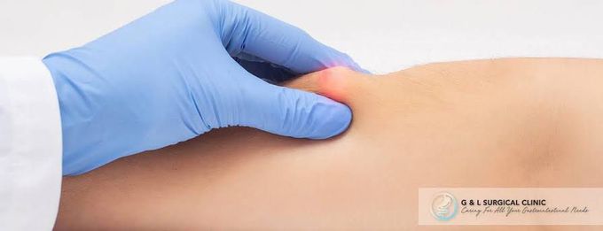 Treatment of lipoma