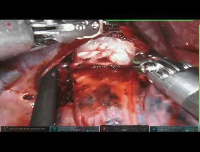 Robotic-Assisted Right Upper Bilobectomy With Pericardial Resection
