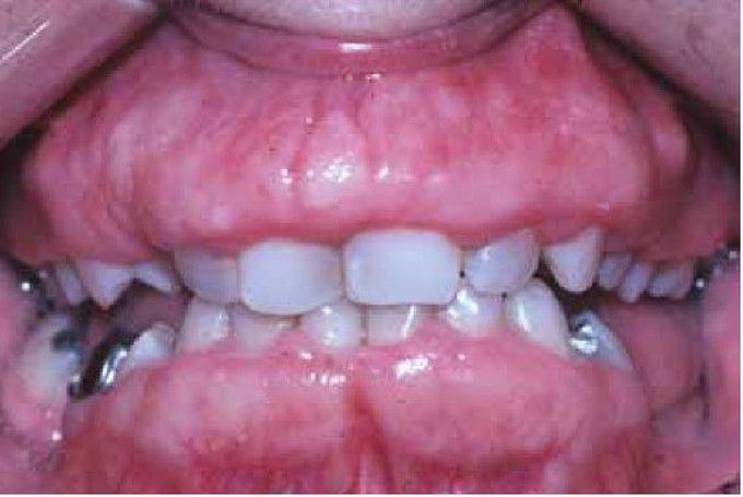 Hereditary Gingival Fibromatosis