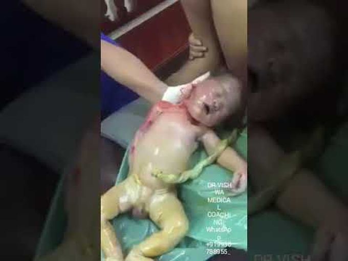 In this case. Ambu bag was not available..But still doctor managed mouth-to-mouth respiration in those vital seconds to get the baby back to life..