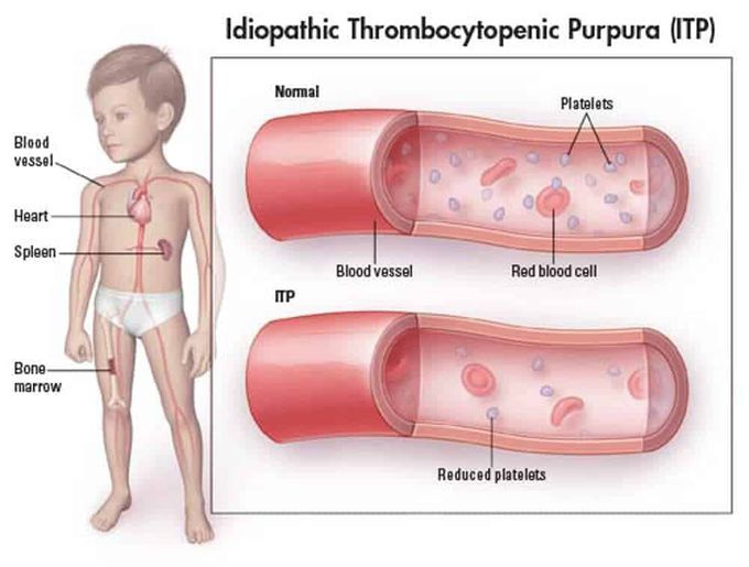 Idiopathic Thrombocytopenia purpura