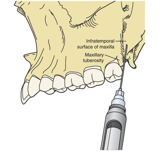 Posterior superior alveolar nerve