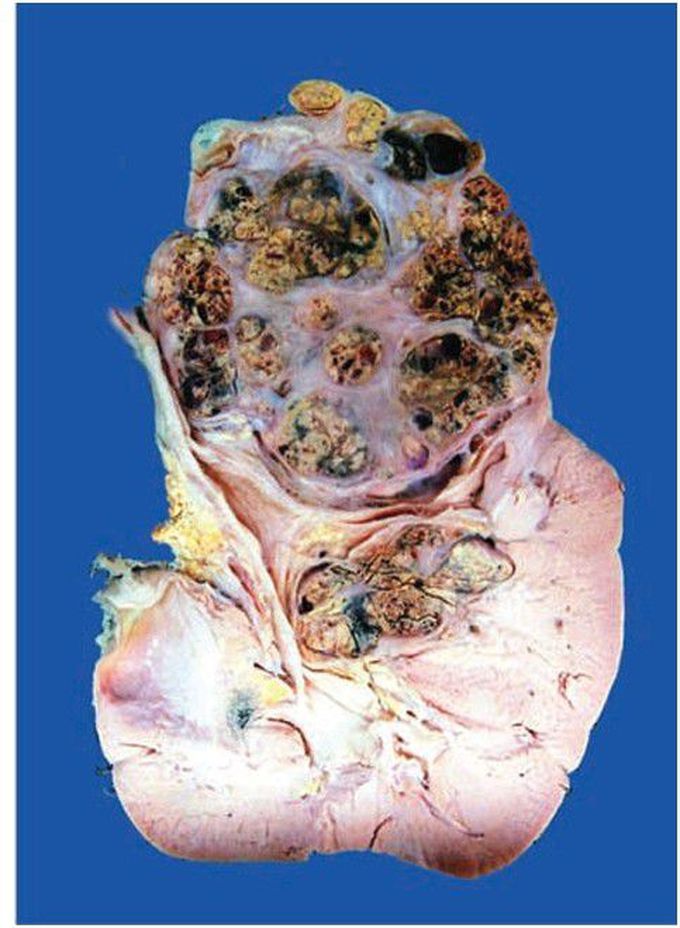 Renal cell carcinoma